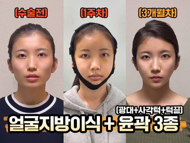 [안면윤곽 3종 + 얼굴지방이식] 수술전부터 수술 후 ...
